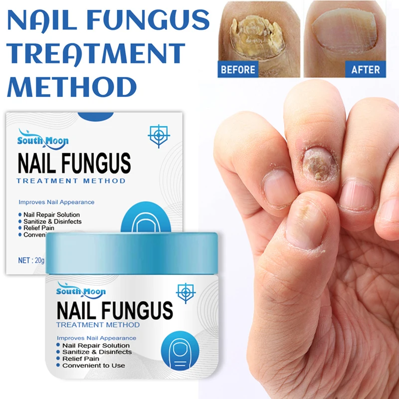 

Fungus Nails Treatment Serum Cream Repair Toe Nail Fungal Removal Gel Onychomycosis Anti-Infection Paronychia Care Ointment 20G