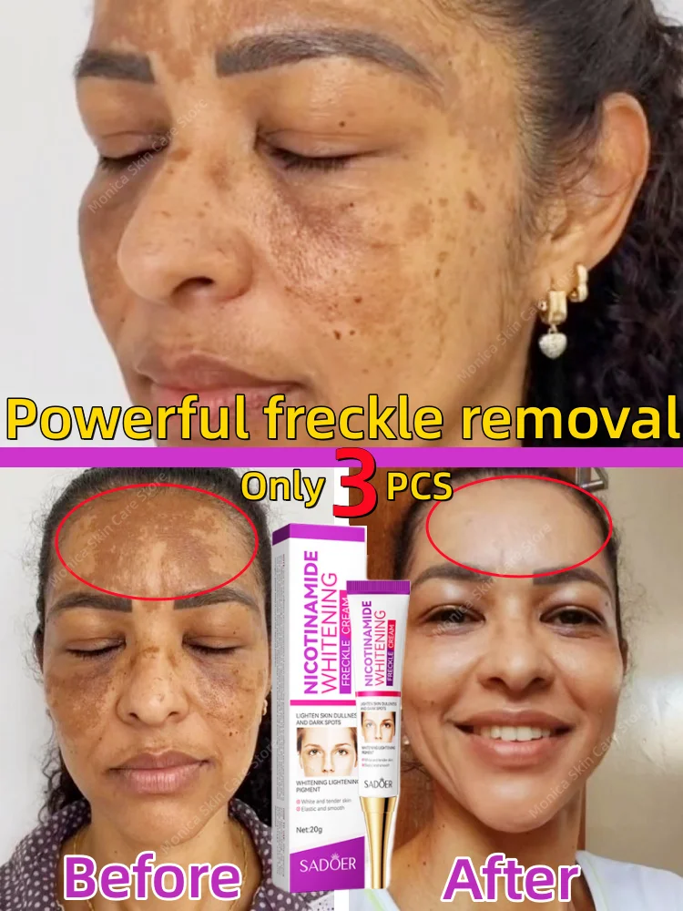 Powerful Nicotinamide Whitening Freckle Remover Cream Anti Brown Dark Spot Lighten Melasma Melanin Face Brighten Korean Skincare