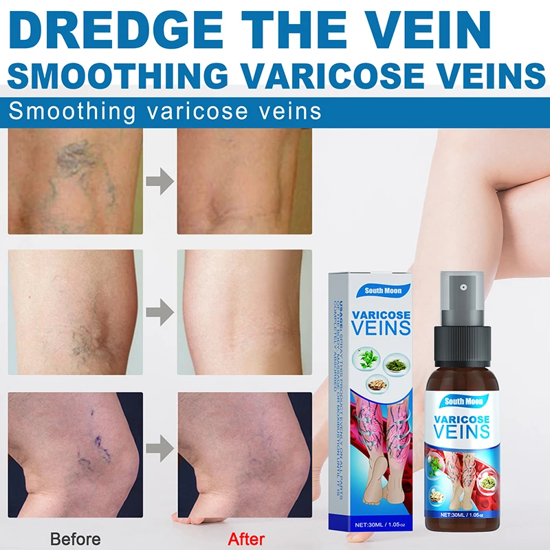 

30ml Veinhealing Varicose Veins Treatment Spray Smoothen The Bulge Of Blood Vessels Earthworm Legs Without Surgery Leg Care Tool