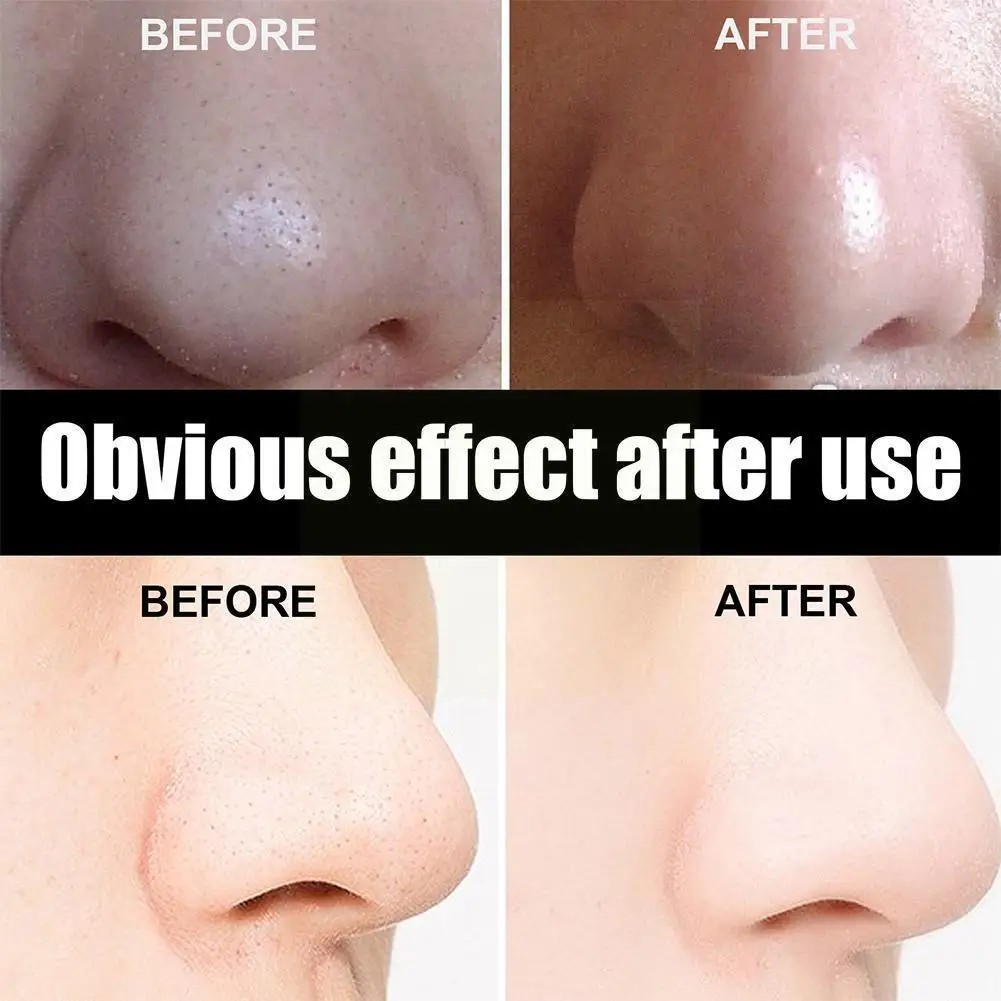 

Bamboo Charcoal Nose Blackhead Remover Deep Cleansing Pore Shrink Nose Care Treatment Skin Treatment Acne Strips W0o1