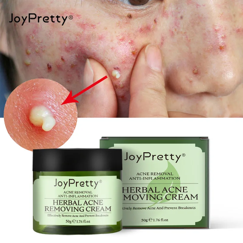 

JoyPretty Tea Tree Anti-Acne Cream Fade Repair Acne-Print Acne-Removal Cream Oil-Control Smoothing Skin Plant Cream Facial 50g