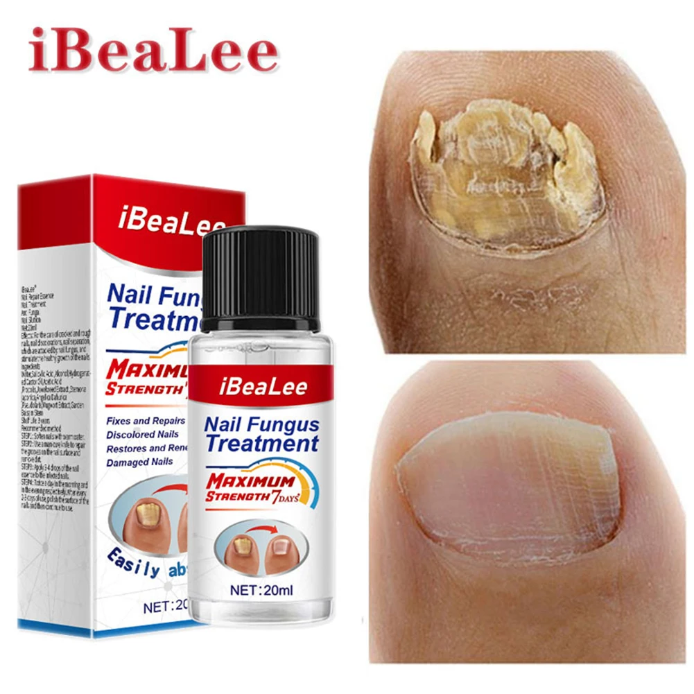 

20ml Nail Fungal Treatment Fluid Anti Infection Onychomycosis Nail Care Essence Improve Rough Nail Oil Safe Repair Nail Products