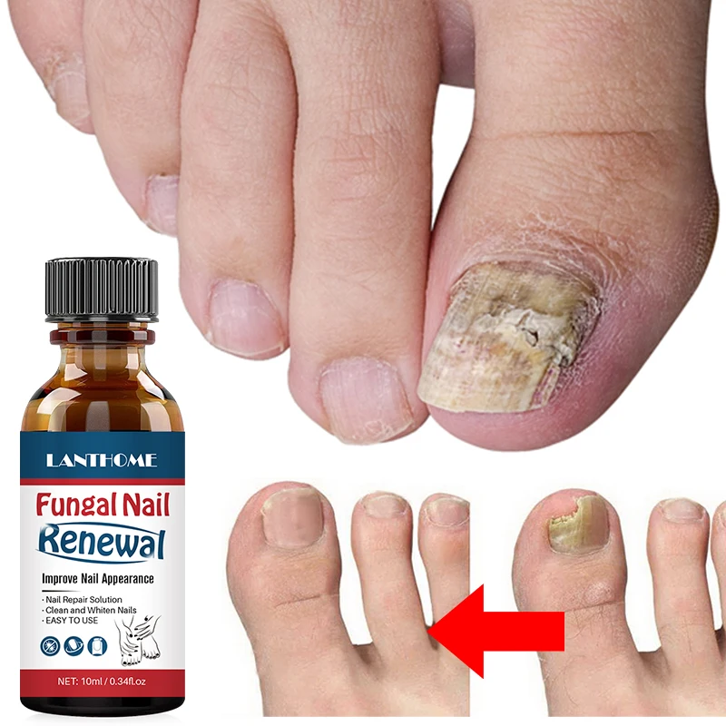 

Nail Fungal Treatment Oil Feet Care Repair Essence Toe Nail Fungus Removal Gel Anti Infection Remedy Liquid