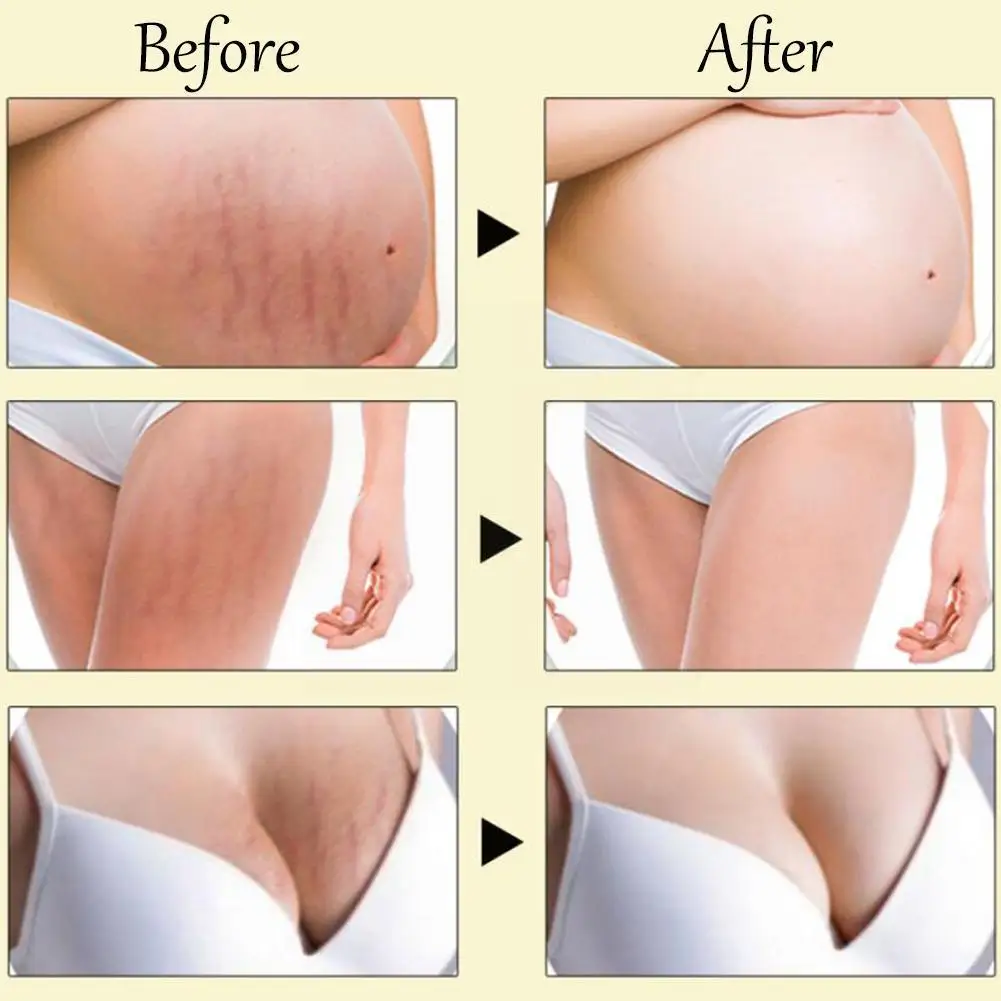 

Крем для восстановления кожи и тела при беременности, растяжки, сыворотка для шрамов, уход за шрамами Tslm1, гладкие послеродовые крем для бере...