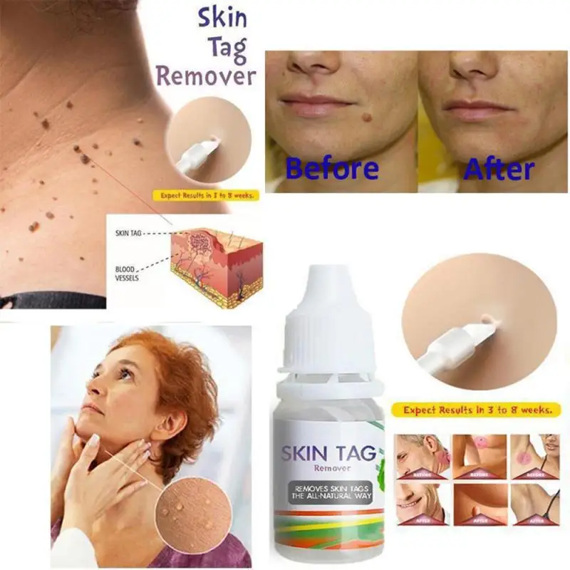 

10ml Skin Tag Remover Chinese Medicine Skin Warts Removal Plantar Warts Skin Care Foot Health Care Ointment