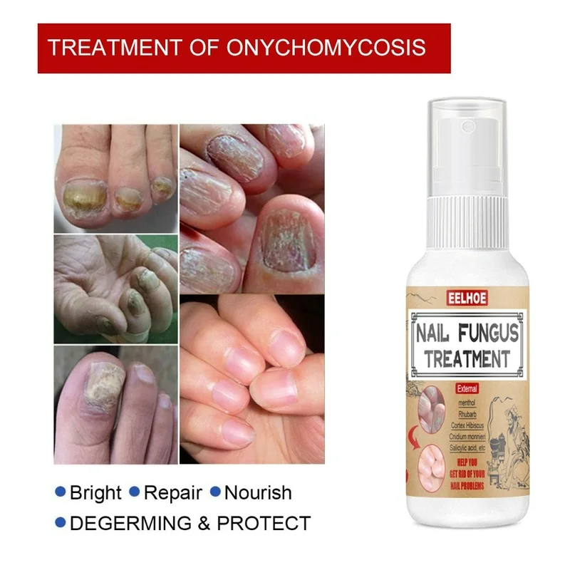 Фото 30ml Nail Fungal Treatment Spray Feet Repair Serum Nails Foot Toe Fungus Removal Gel Anti Infection Paronychia Onychomycosis №4