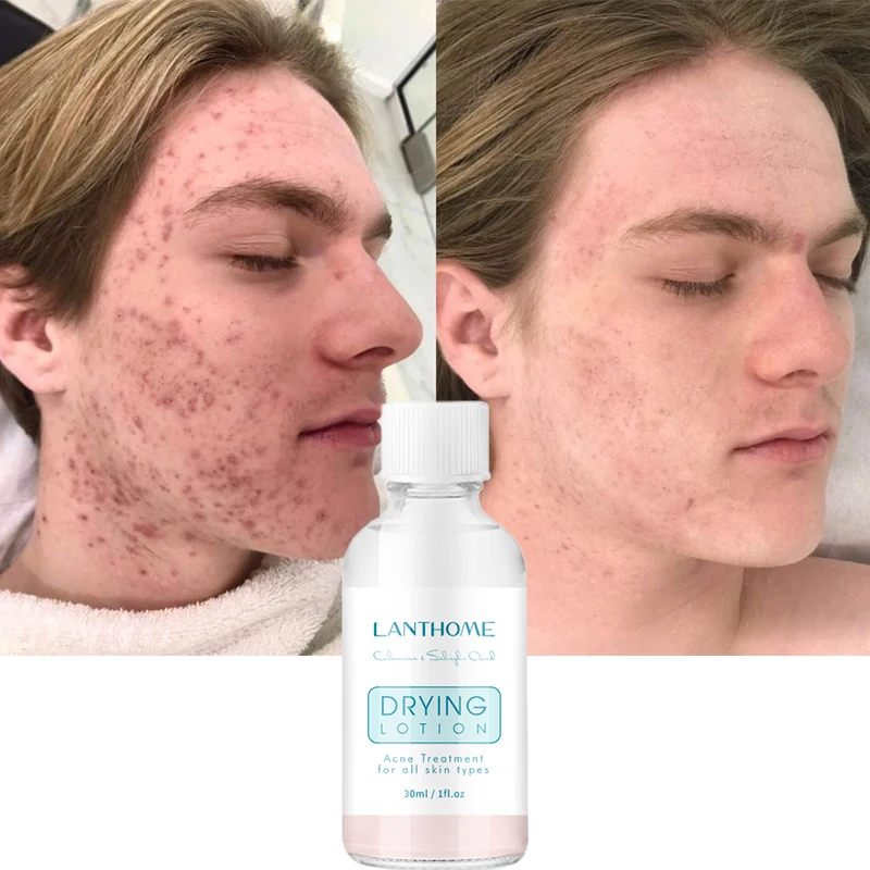 

30ml Acne Removal Serum Salicylic Acid Anti-Acne Repair Fade Acne Spots Pimple Oil Control Whitening Moisturizing Skin Care