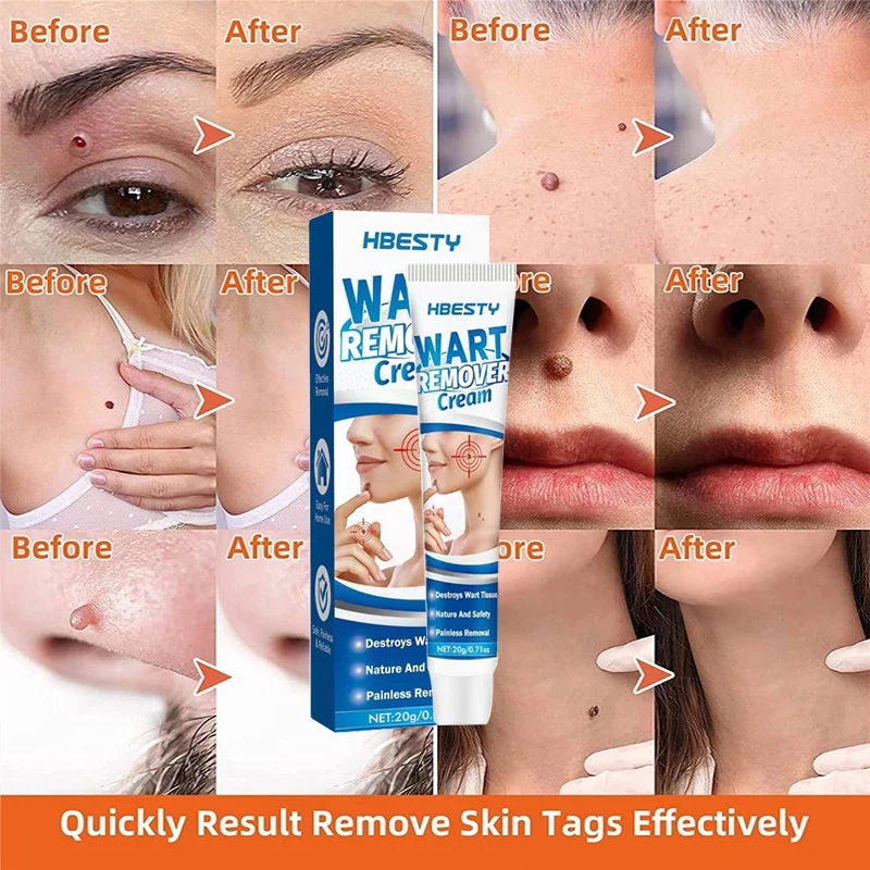 

Body Wart Removal Essential Oil Set Facial Mole Removal Serum Cream Painless Elimination Skin Tag Powerful Wart Removal Serum