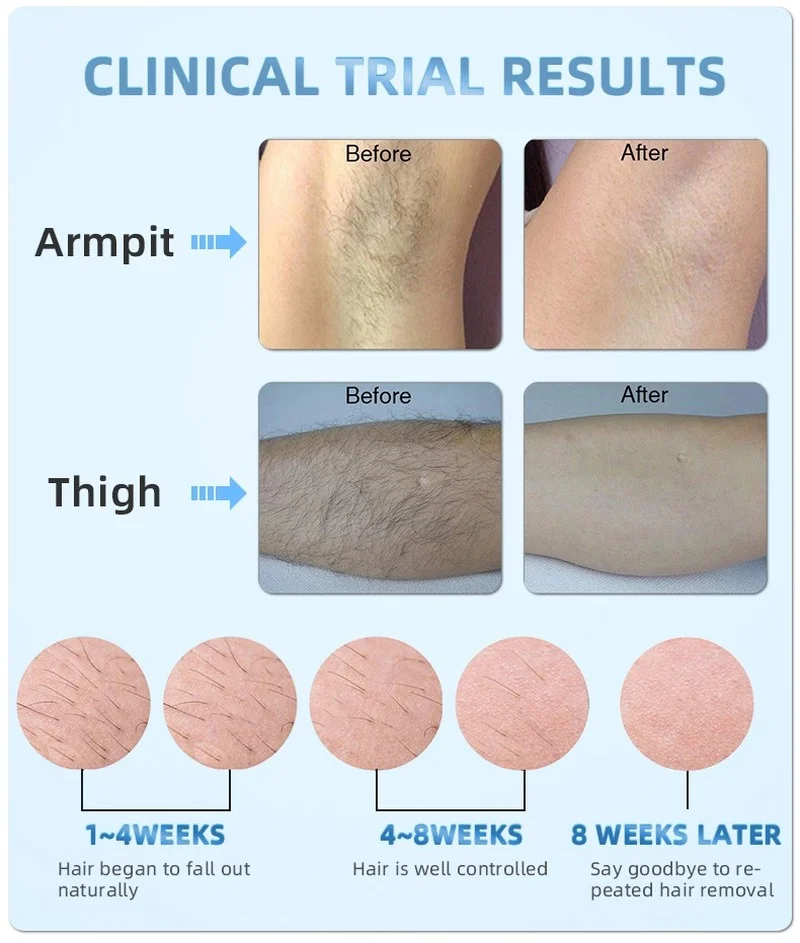Лазерное устройство для холодного ледяного удаления волос Mlay Laser T5 лазерная