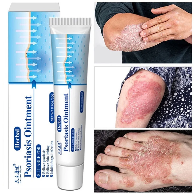 

Chinese Psoriasis Eczema Cream Antibacterial Ointment Relief Itchy Allergic Rash Dermatitis Urticaria Desquamation Treatment 20g