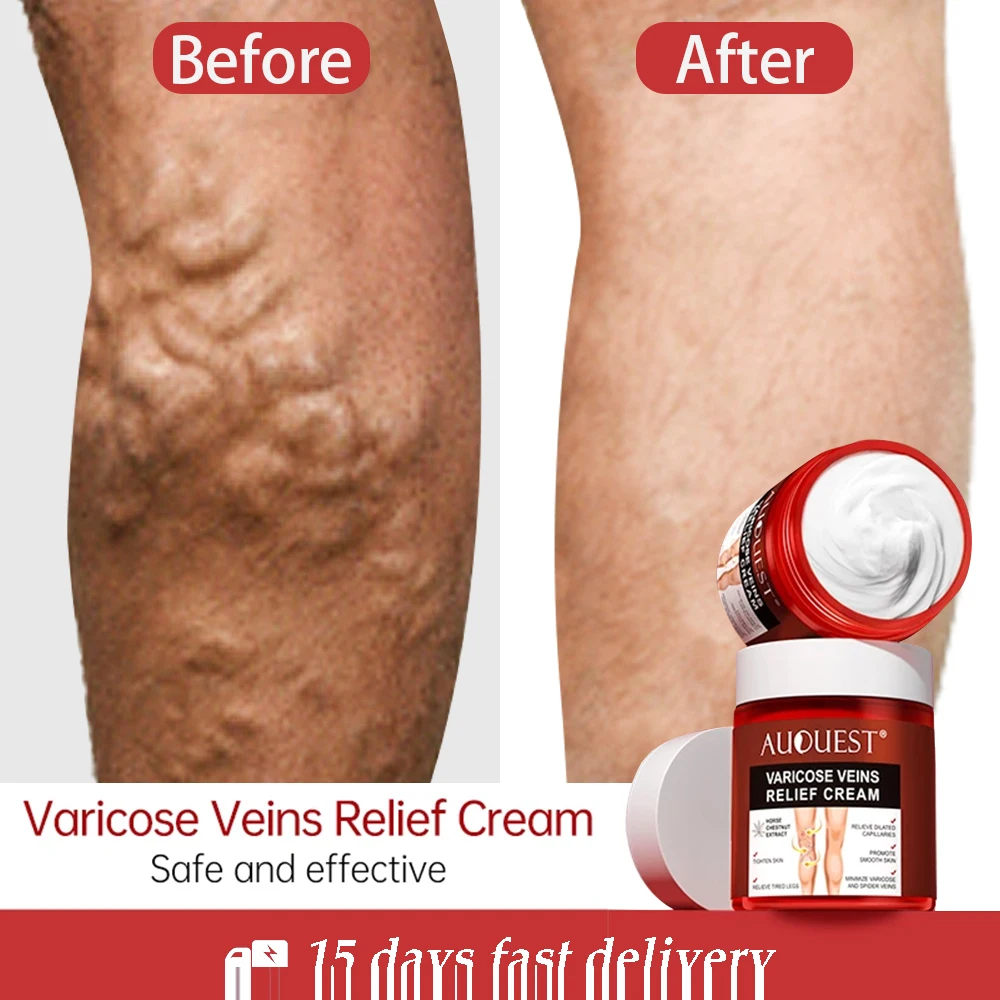 

Varicose Veins Relief Cream Vasculitis Phlebitis Spider Pain Relief Ointment Medical Plaster Varicose Veins Treatment Body Cream