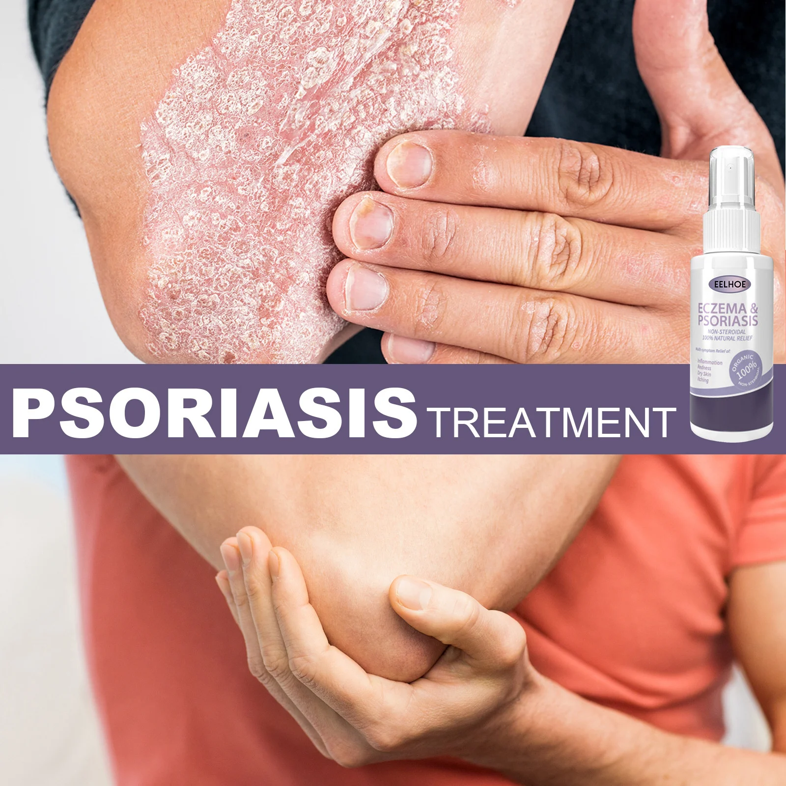 

Травяная быстрая эссенция против зуда псориаз дерматит экзема сыпь уртикария лечение десквиации уход за кожей тела