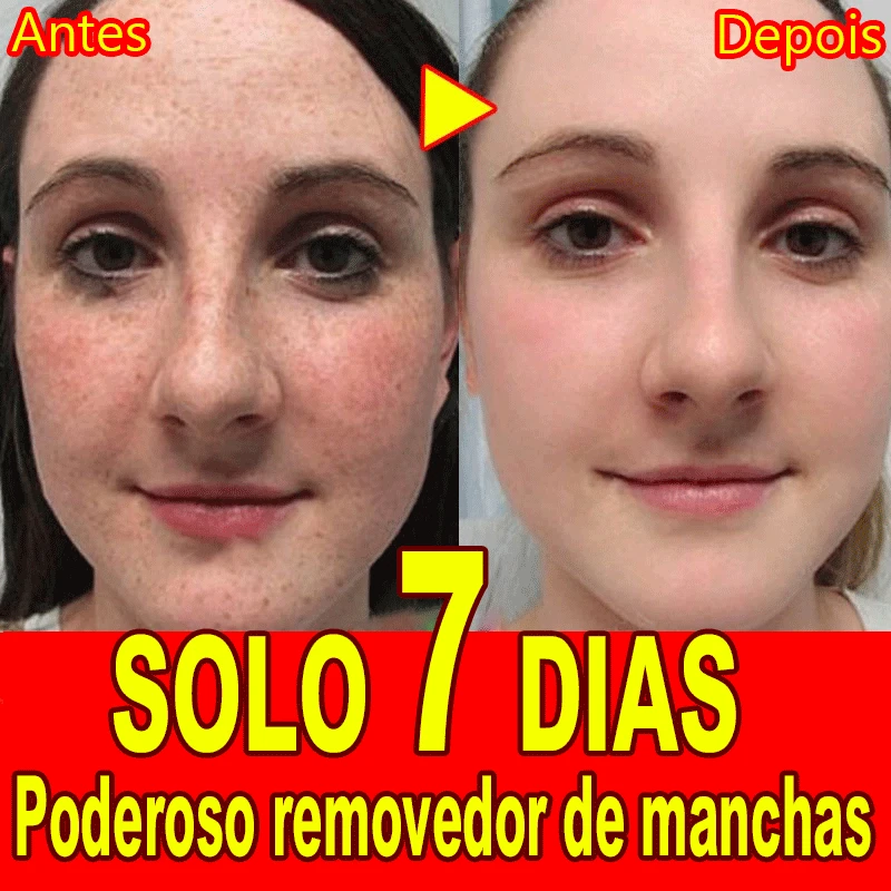 

Whitening Spot Serum Remove Freckles Chloasma Dark Spots Hyperpigmentation Age Spots Sun Spots Light Spots And Brighten Skin