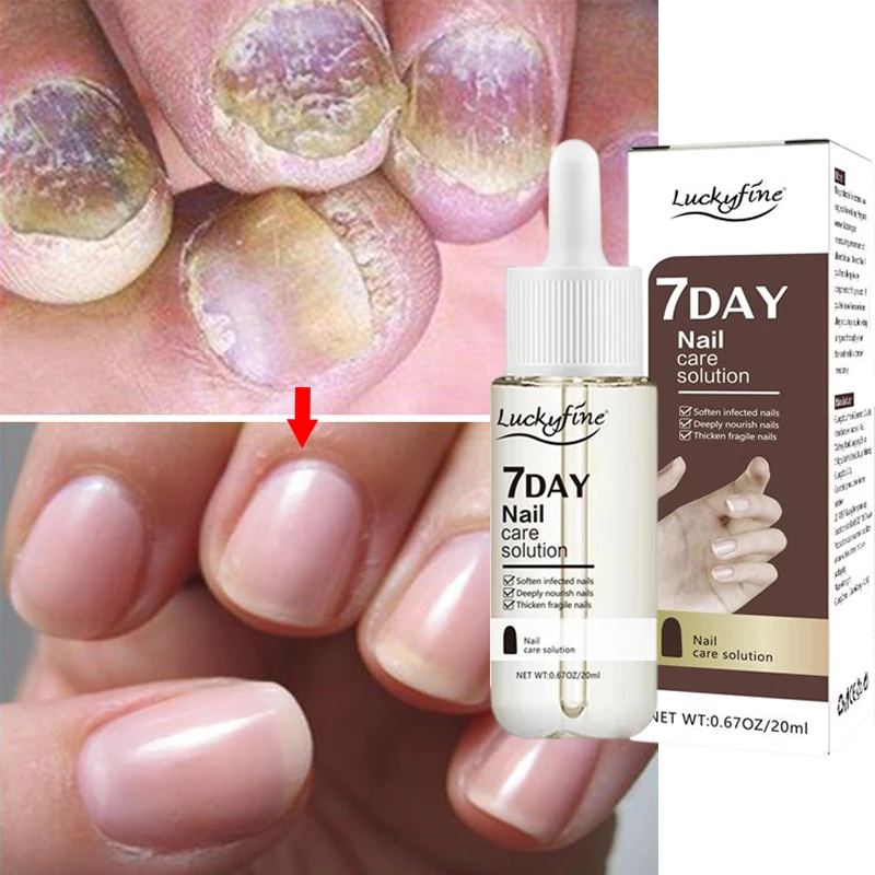 

Nail Fungal Treatment Essence Onychomycosis Paronychia Anti Infection Toe Fungus Hands Foot Removal Repair Serum Beauty Health