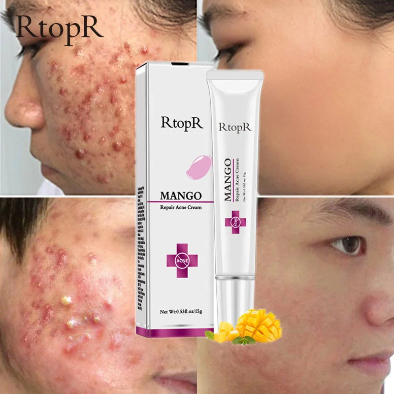Tratamento da acne creme facial eficaz acne manchas controle de óleo acne creme cuidados com a pele clareamento hidratante gel cosméticos coreano 20g