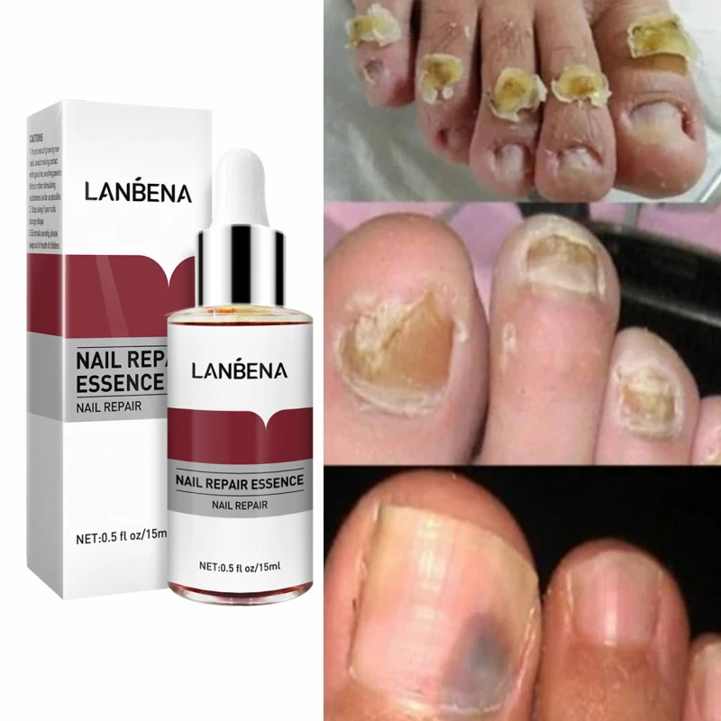 

LANBENA 10pcs Wholesale Nail Fungus Treatment Essence Serum Care Hand and Foot Care Removal Repair Gel Anti-infective