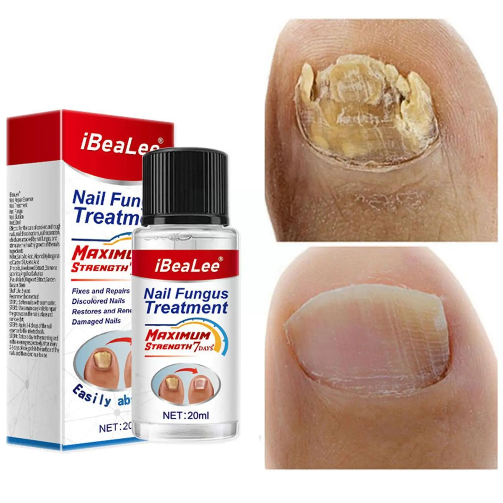 

20ml Nail Fungus Treatment Essence Serum Care Oil Hand Fungal Nails Anti-infective Removal And Care Foot Repair Gel P1s9