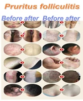 3pcs buttock damp heat eczema dark acne skin lump psoriasis pele foliculite quick anti pruritic bacteriostatic skin problem