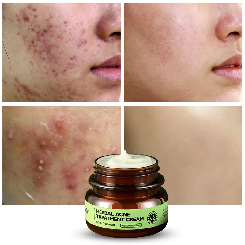 Herbal Acne Treatment Cream Oil Control Brighten Nourish Whitening Shrink Pores Remove Scars Marks Skin Care