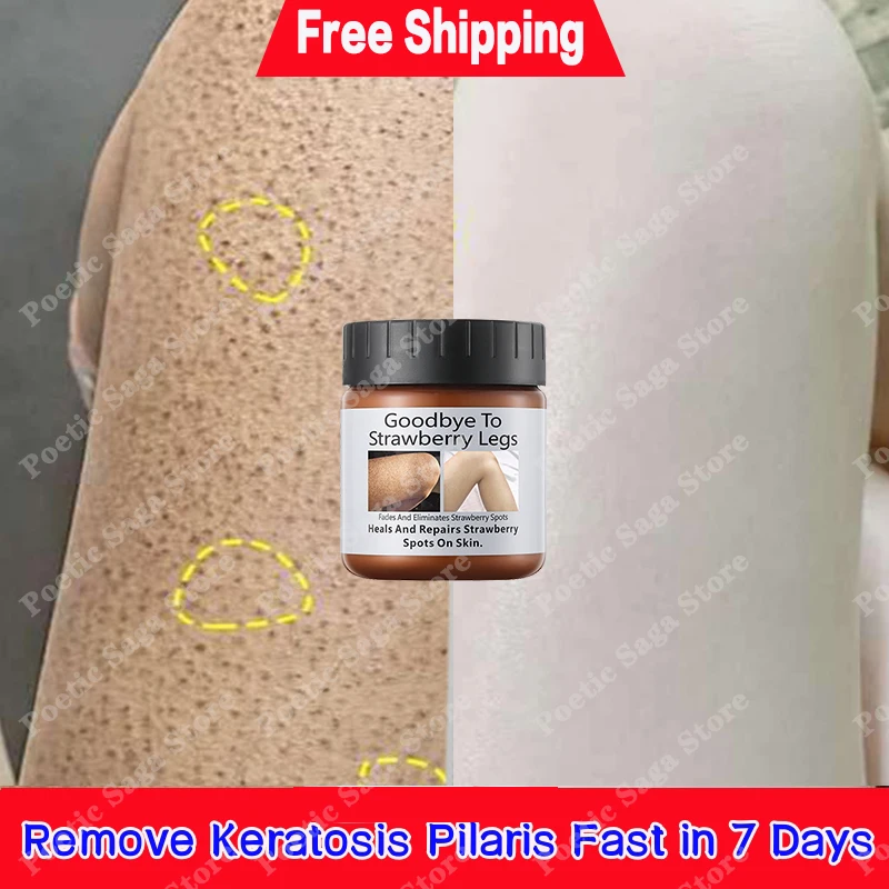 

Body Cream Chicken Skin Removal Treatment Keratosis Pilaris Lotion Rough Bumpy Pore Spots Care Moisturizer Whitening Creams