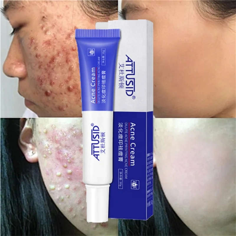 

Acne Face Cream Anti-acne Treatment Moisturizing Scar Blackhead Shrink Pores Whitening Facial Skin Care Acne Treatment Cream