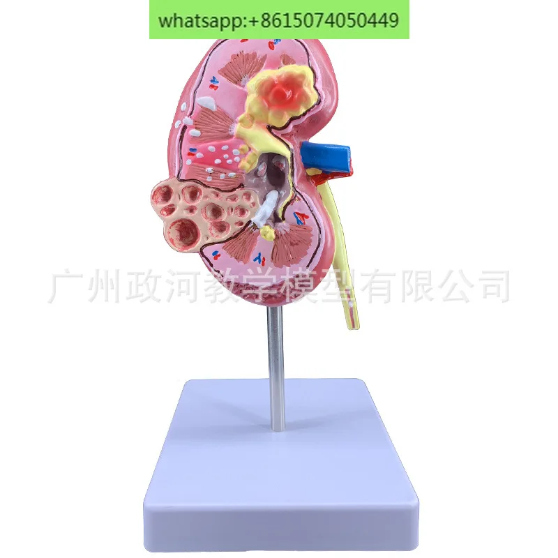 Моделирование обучения модель патологической почки образец почечной анатомии