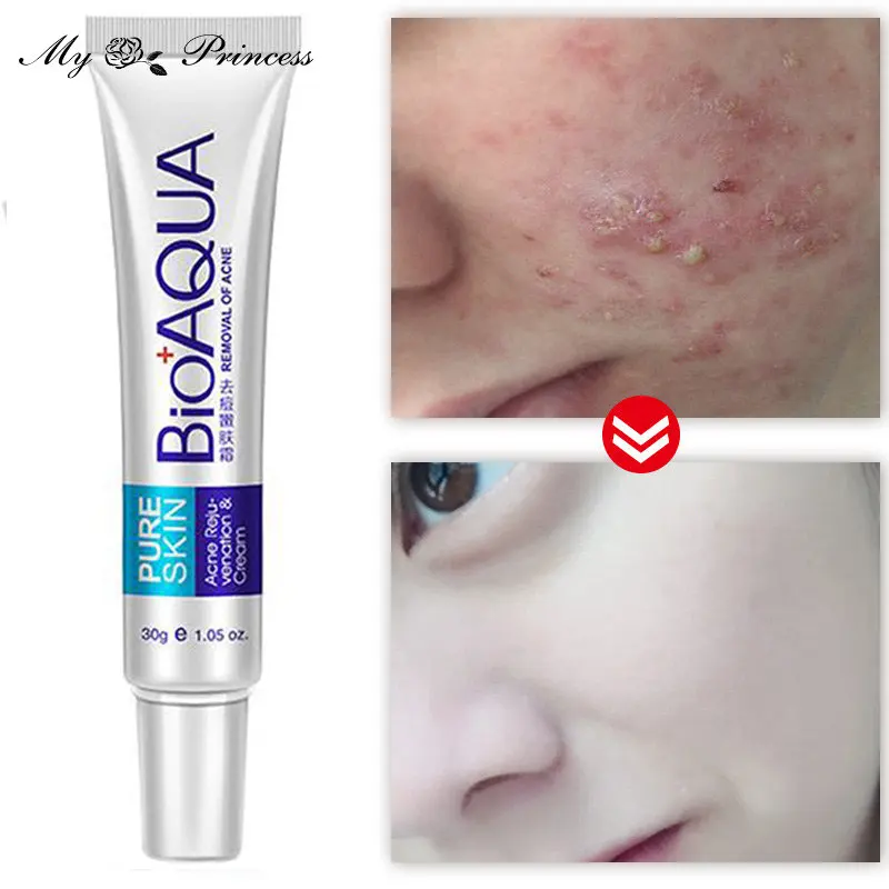 

Эффективный крем для удаления акне, лечение акне, удаление пятен от акне, контроль жирности, сужение пор, отбеливание, гель для лица, уход за ...