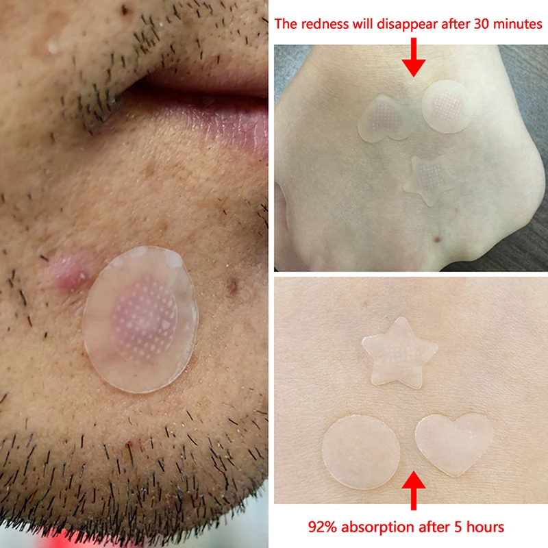 Водорастворимые наклейки для удаления салициловой кислоты акне микроиглы