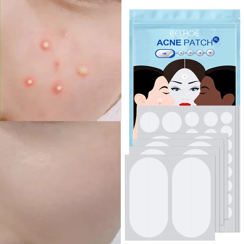 

80pcs/set Acne Patches Large Size Hydrocolloid Acne Invisible Pimple Master Patch Skin Tag Blackhead Blemish Removers Skin Care