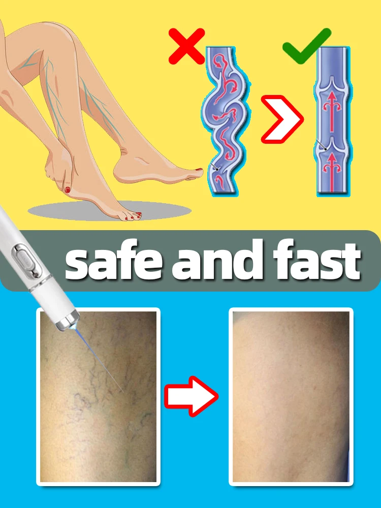 Выбор дня предложения лазер от варикозного расширения вен для вас