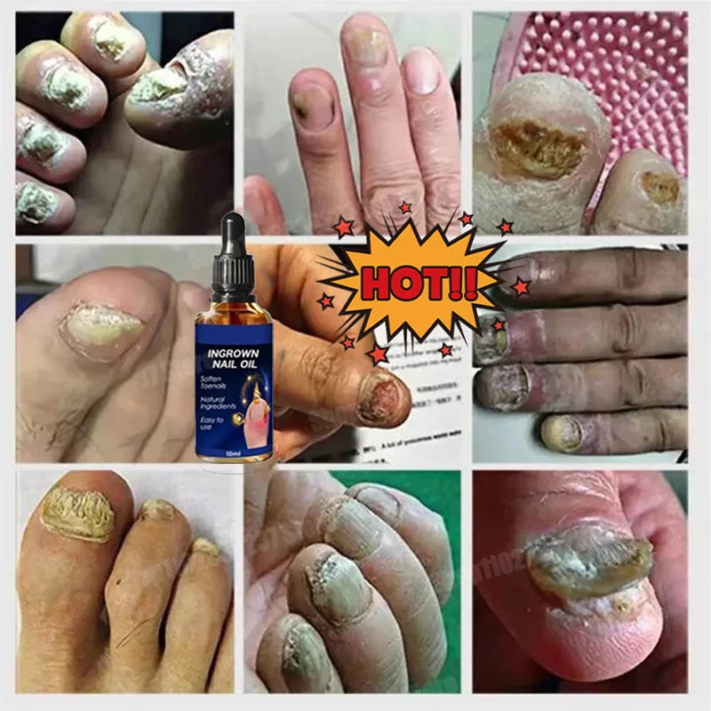Средство для ухода за ногтями грибковая эссенция ногами против инфекции