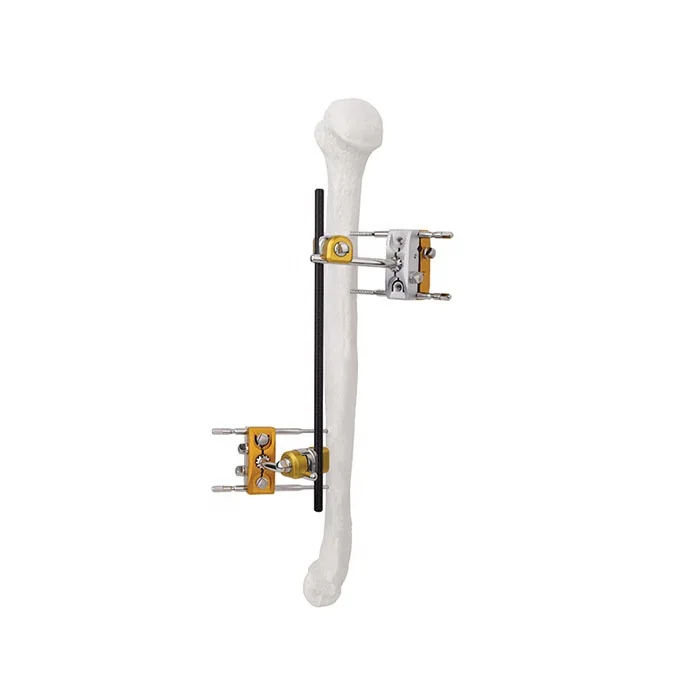 

Factory Price Orthopedic External Fixation Humeral Shaft External Fixators