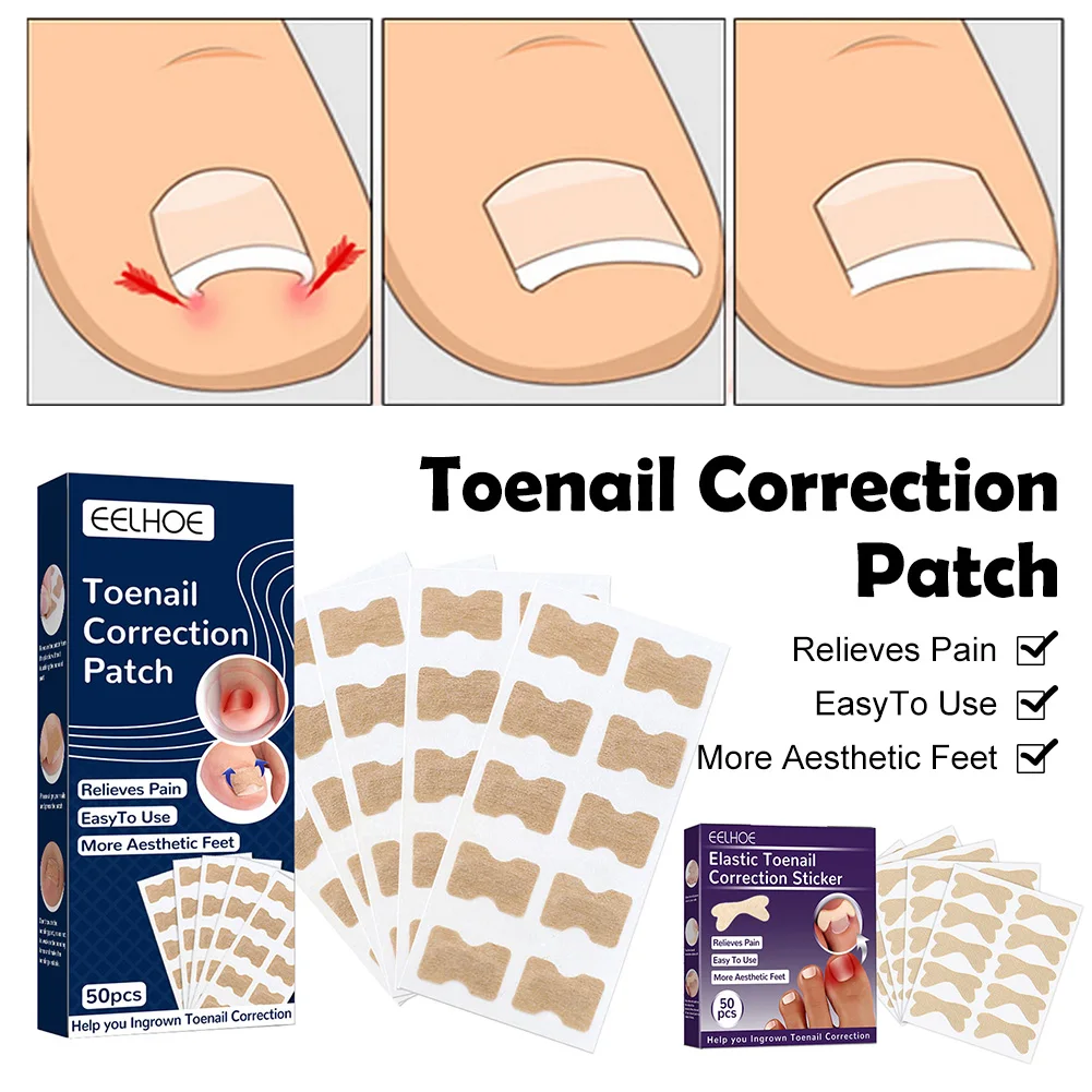 

50 шт., наклейки для коррекции вросших ногтей