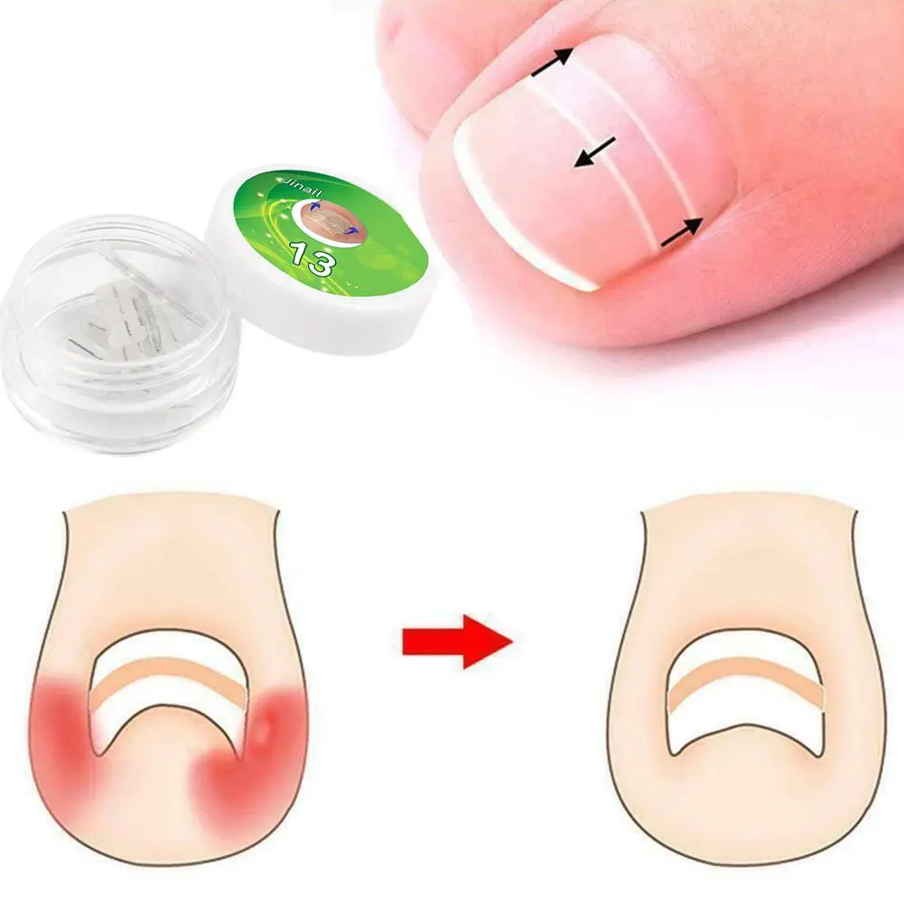 

Корректор для ногтей, инструмент для коррекции вросших ногтей, клипса для лечения Ногтей, скоба, инструмент, патч, выпрямление, эластичная наклейка, педикюр Y5G9