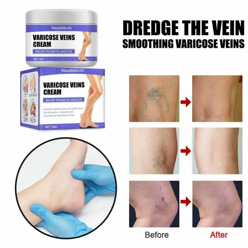 

2023 Latest Varicose Vein Ointment Vascular Pain Treatment Phlebitis Vasculitis Rotten Leg Spider Leg Treatment Cream 30g