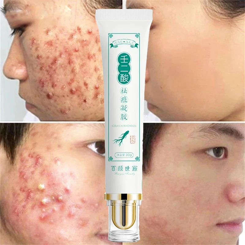 

Эффективный крем для удаления акне, лечение акне, увлажнение, отбеливание, уход за кожей