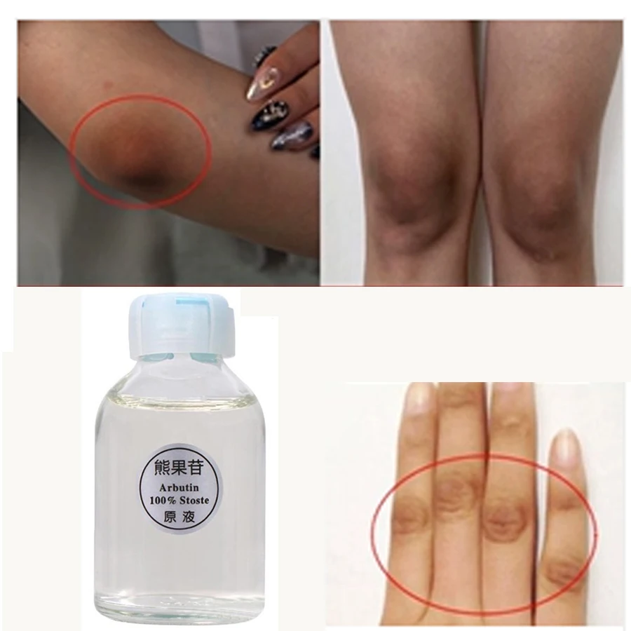 

New Arbutin Skin Brightening Essence Liquid For Removing Chloasma Lightening Brightening Serum Kojic Acid Bleaching Cream