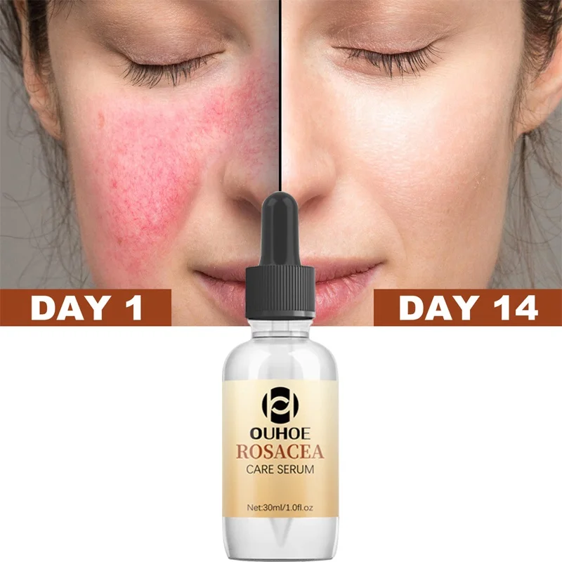 

Repair Facial Redness Serum Moisturizing Repair Essential Oil Soothing Sensitive Anti-Inflammatory Beauty Skin Care Products