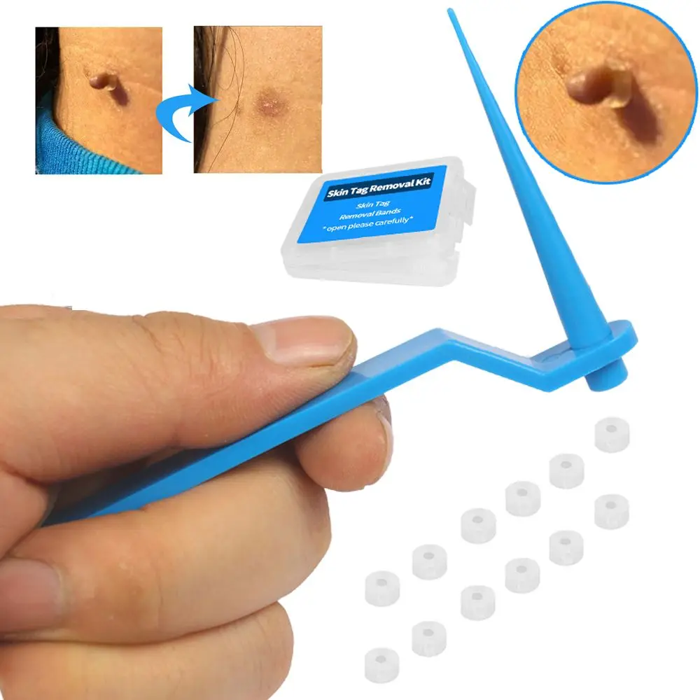 

Green Beauty & Health Rubber Bands Alcohol Pads Skin Tag Remover Skin Tag Removal Kit Face Care Mole Wart Tool