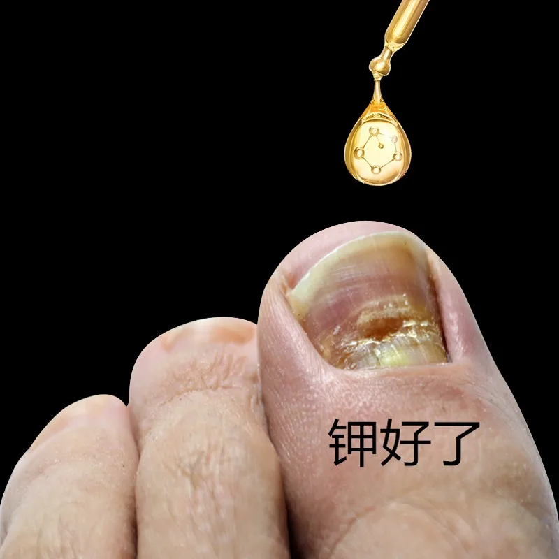 [Hot Sale in Tongrentang] Painless Replacement of New Potassium Enjoy a Good Nail Life Bad Become Jia Drop
