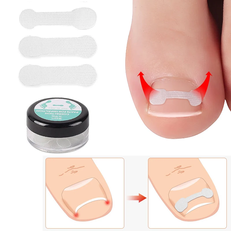 

Sdotter 10PCS Ingrown Toe Nail Treatment Ingrown Toenail Correction Tool Elastic Patch Sticker Straightening Clip Brace Pedicure