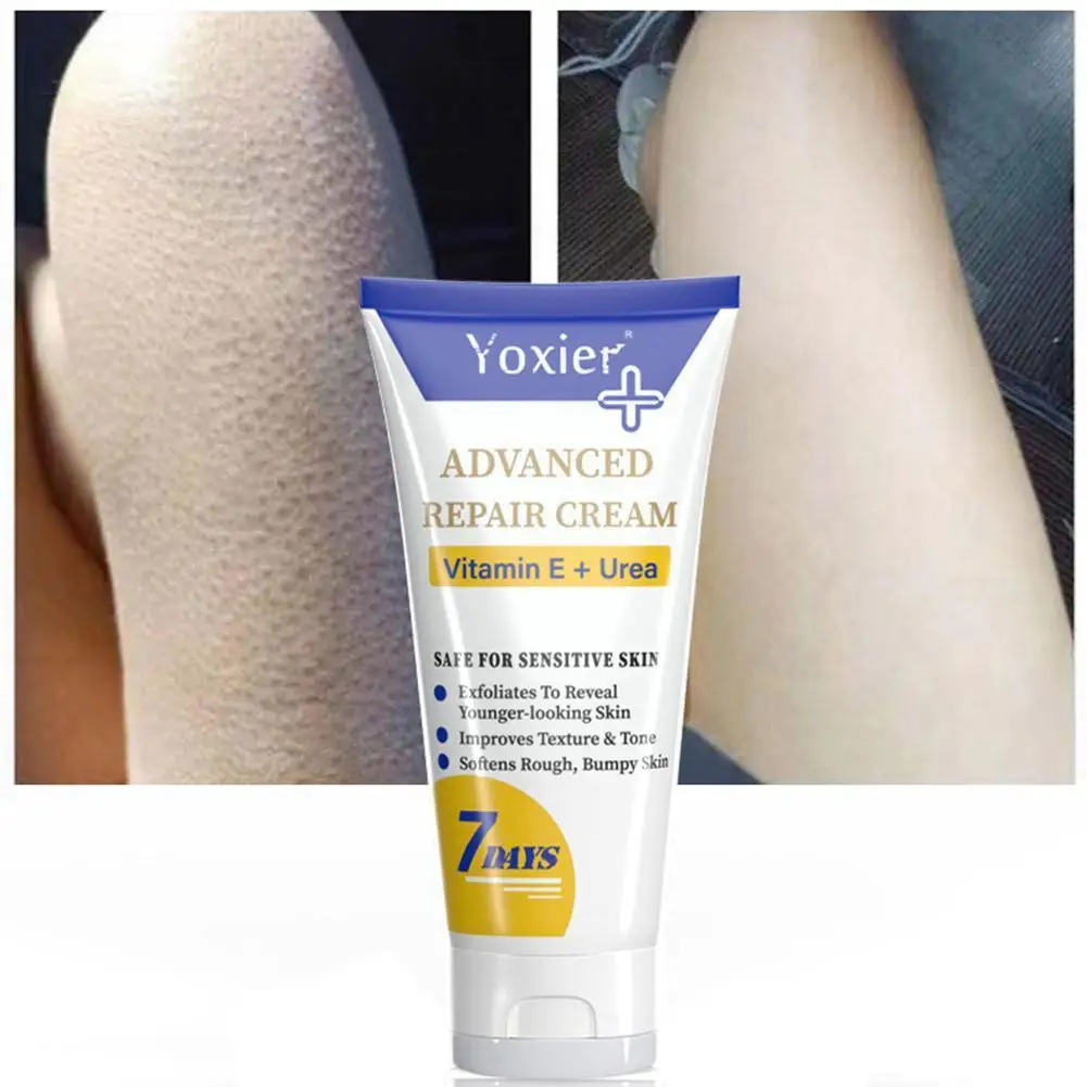 

50g Curing Keratosis Pilar Repair Cream Remove Chicken Dark Spots Body Beauty Health Smooth ​Care Skin Lotion Pores Moistur N7R1