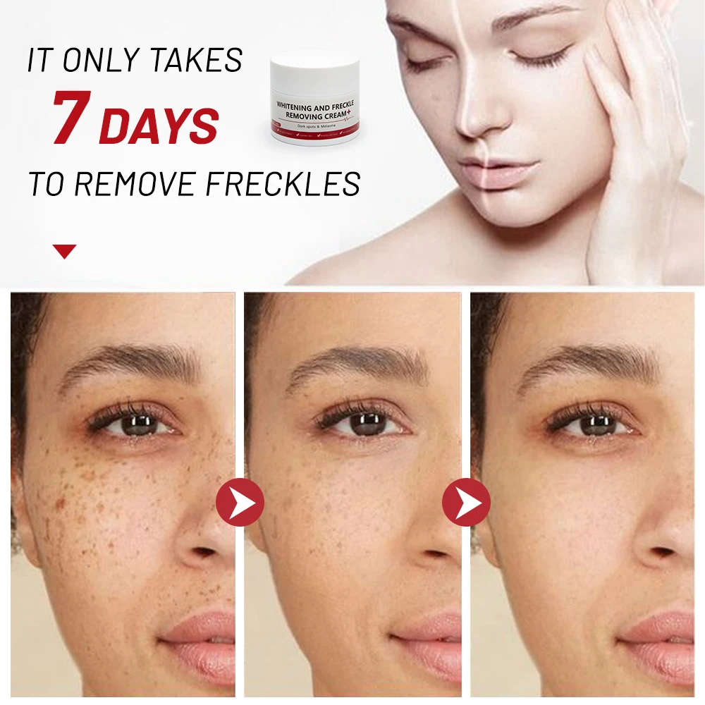 Отбеливающий и крем против веснушек удаляет темные пятна солнечные