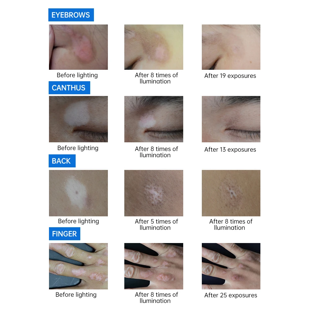 311nm Uvb Vitiligo лампа оборудование для физиотерапии узкополосные