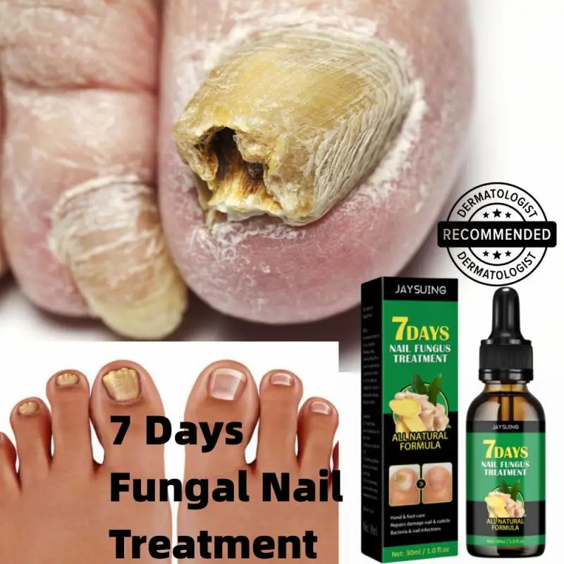 

7DAYS Nail Fungus Treatment Essence Serum Anti-Infection Onychomycosis Paronychia Hand Care Nails Foot Fungal Removal Gel 30ml