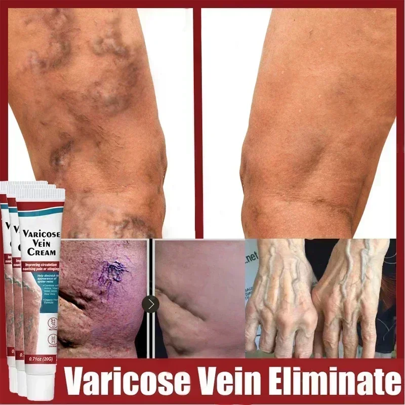 Varicose Veins Removal Cream Effective Treatment Vasculitis Earthworm Spider Leg Pain Repair Plaster Phlebitis Relief Ointment
