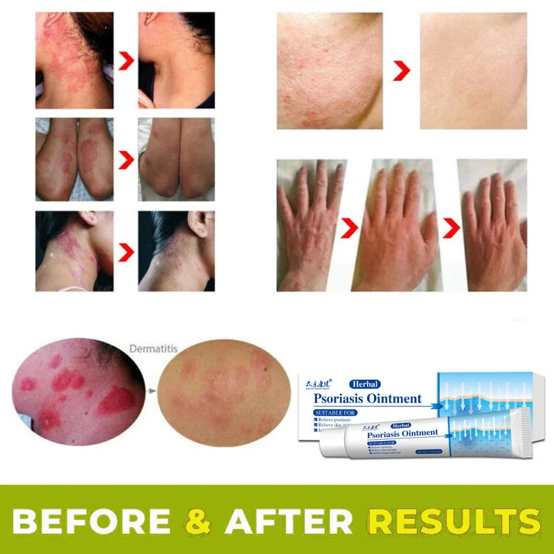 Antibacterial Cream Psoriasis Herbal Treatment Eczema Anti-itch Relief Rash Urticaria Desquamation Ointment Body Skin Care |