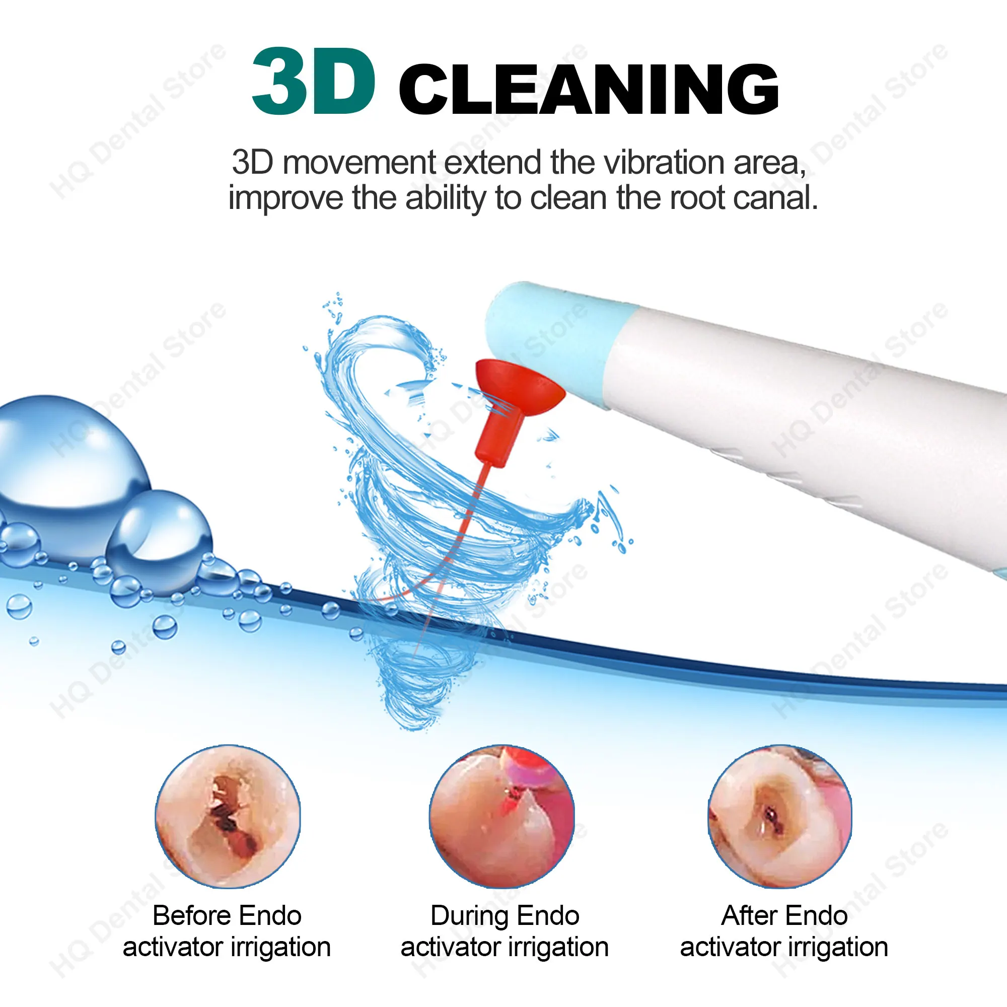 Фото Ирригатор для эндодонтии Twoendo Dentistry Endo Sonic с 120 насадками, вибрационный очиститель для стоматологов, инструмент для лечения корневых каналов №4