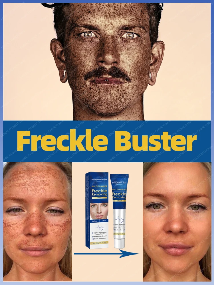 

Freckles Removal Cream Remove Facial Spots Dark Spot Melasma Age Spots Sunspots Whitening Skin