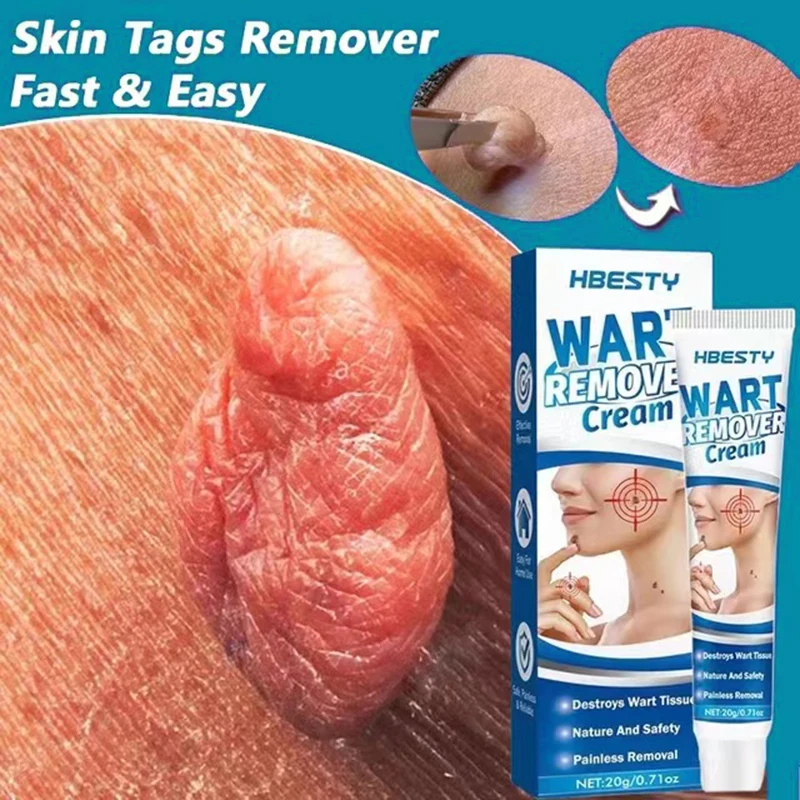 

Wart Remover Cream Painless Mole Skin Dark Spot Warts Remover Serum Freckle Face Wart Tag Treatment Removal Essential Oil